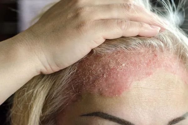 best-dermatologist-for-eczema-treatment-in-gurgaon-big-0