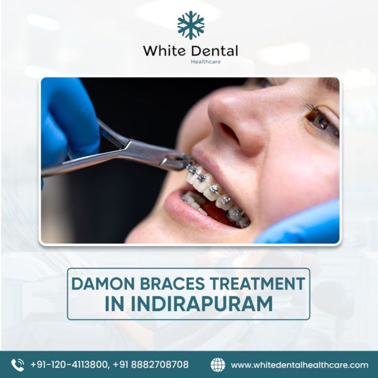 best-damon-braces-treatment-in-indirapuram-big-0