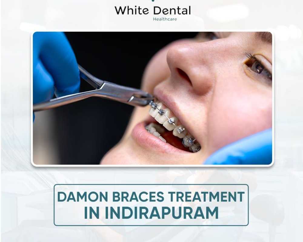 best-damon-braces-treatment-in-indirapuram