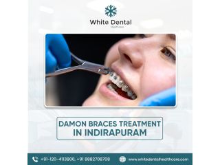 best-damon-braces-treatment-in-indirapuram-small-0
