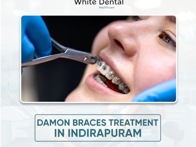 best-damon-braces-treatment-in-indirapuram
