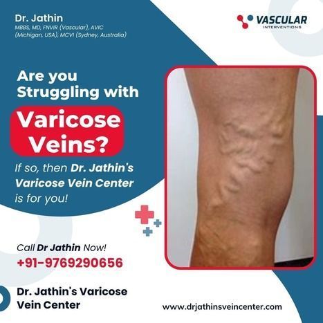 expert-vein-treatment-for-better-circulation-health-big-0