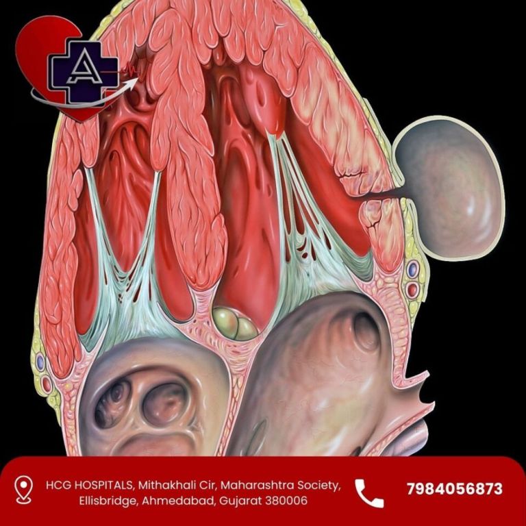 left-ventricular-aneurysm-treatment-in-ahmedabad-dr-parmar-big-0