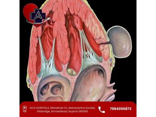 left-ventricular-aneurysm-treatment-in-ahmedabad-dr-parmar-small-0