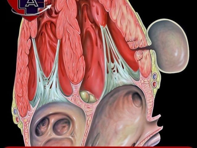 left-ventricular-aneurysm-treatment-in-ahmedabad-dr-parmar