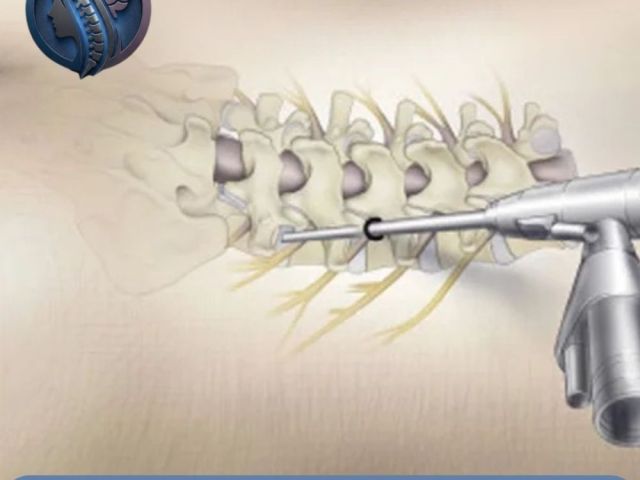 best-endoscopic-spine-surgery-in-ahmedabad-dr-deep-parmar