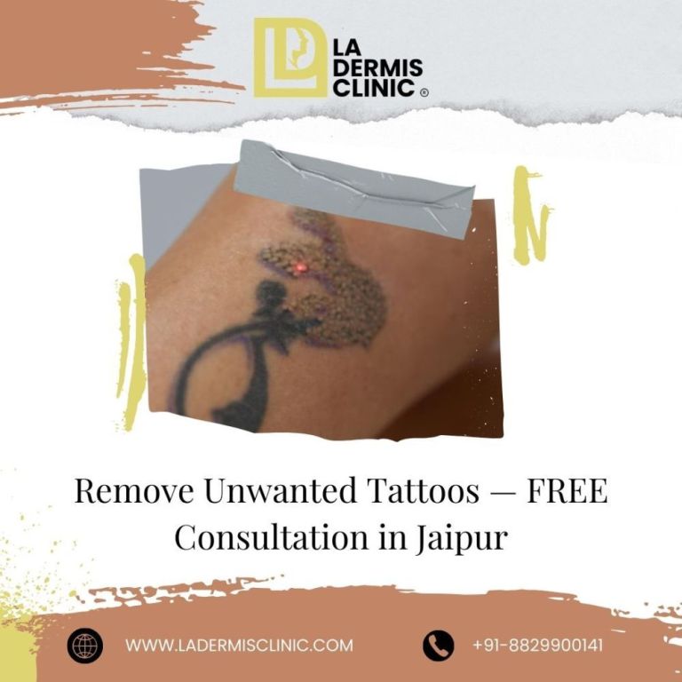 remove-unwanted-tattoos-free-consultation-in-jaipur-big-0