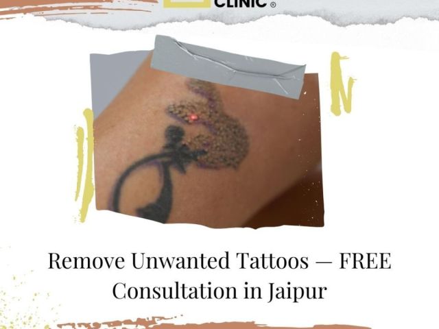 remove-unwanted-tattoos-free-consultation-in-jaipur