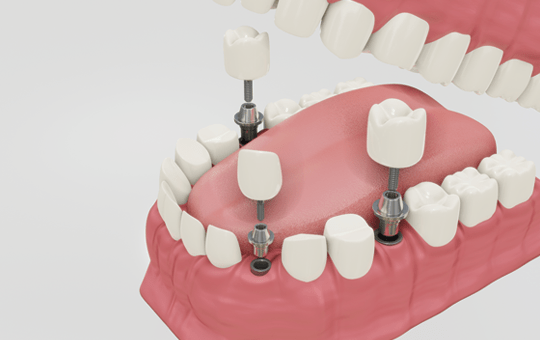 dental-implants-treatment-in-india-dr-manish-shah-big-1