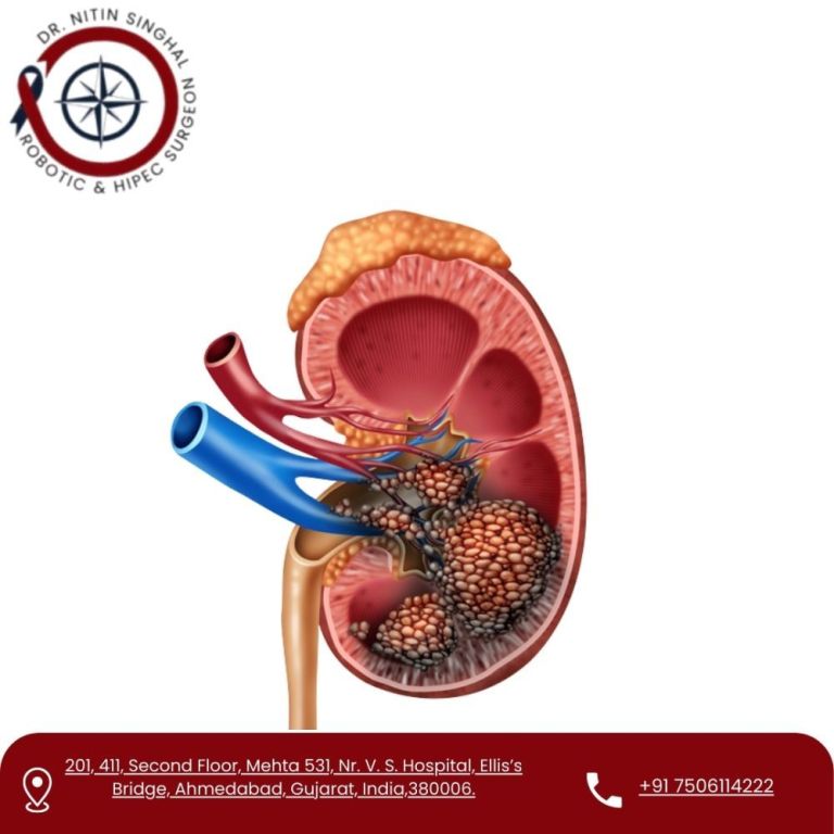 partial-nephrectomy-surgeon-in-ahmedabad-big-0