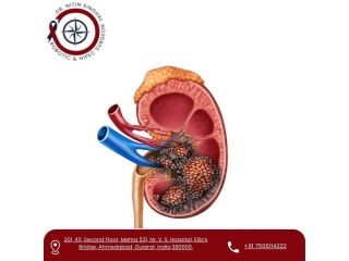 partial-nephrectomy-surgeon-in-ahmedabad-small-0