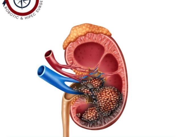 partial-nephrectomy-surgeon-in-ahmedabad