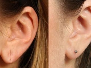 earlobe-repair-correction-ear-hole-stitching-near-me