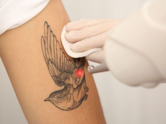 safe-tattoo-removal-clinic-in-ashok-vihar-delhi-today