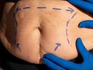 face-fat-reduction-with-coolsculpting-cost-results-safety