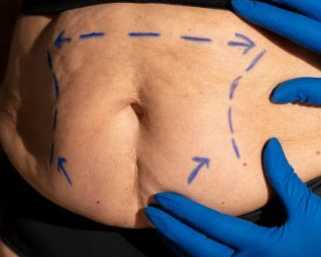 weight-loss-treatment-in-delhi-weight-loss-treatment-cost