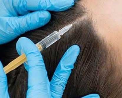 prp-treatment-for-hair-loss-aesthetic-dermatology-clinic