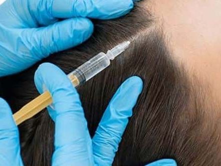 prp-treatment-for-hair-loss-aesthetic-dermatology-clinic