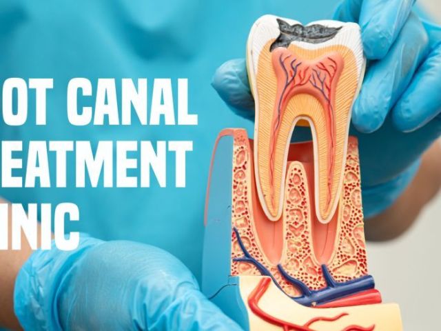 root-canal-treatment-in-hadapsar