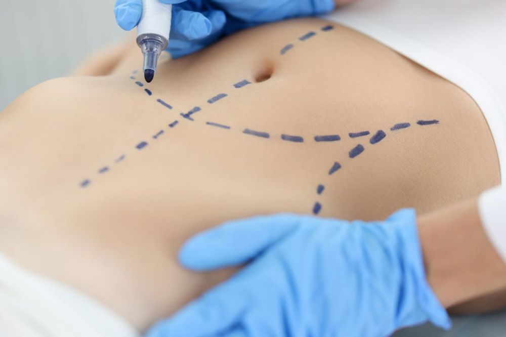 liposuction-surgery-in-delhi-sculpt-your-ideal-body-big-0