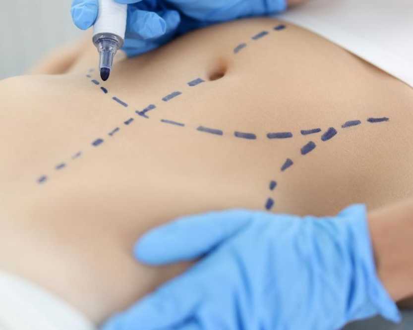 liposuction-surgery-in-delhi-sculpt-your-ideal-body