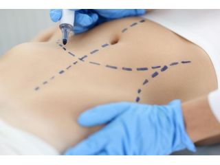 liposuction-surgery-in-delhi-sculpt-your-ideal-body-small-0