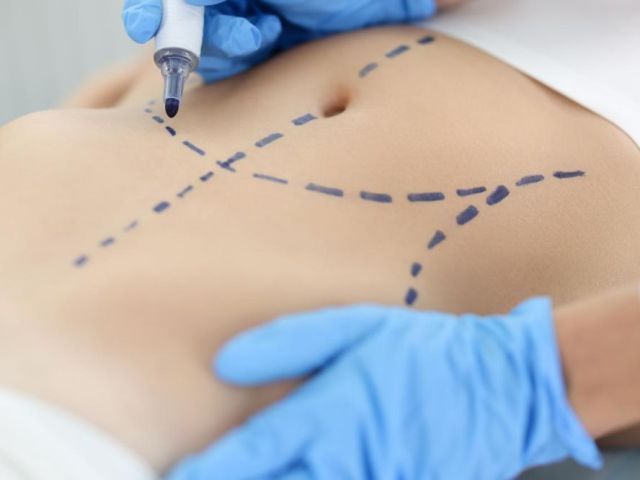 liposuction-surgery-in-delhi-sculpt-your-ideal-body