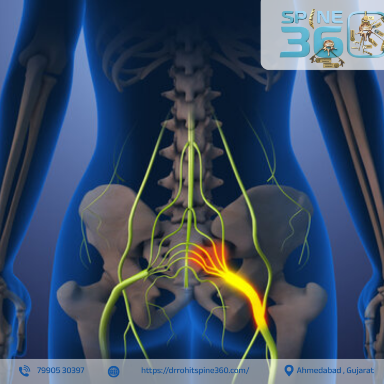 best-sciatica-specialist-in-ahmedabad-dr-rohit-thaker-big-0