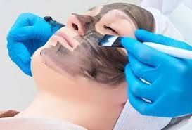 instant-glow-therapy-carbon-peel-at-citrine-clinic-gurgaon-big-0