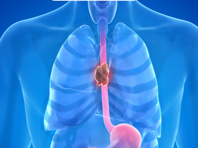 leading-esophageal-cancer-surgery-in-ahmedabad-dr-dhaval-patel