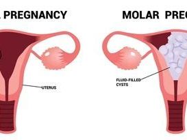 advanced-molar-pregnancy-treatment-in-kolkata-uma-medical