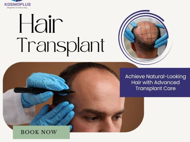 restore-your-hairline-with-an-expert-hair-transplant-in-ahmedabad
