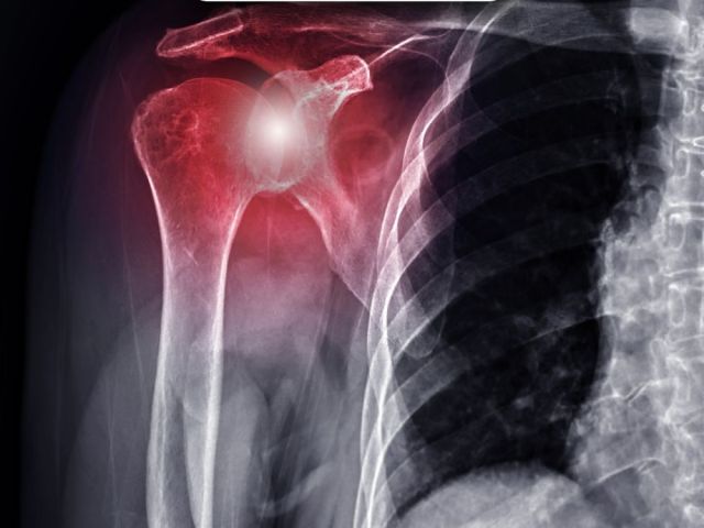 advanced-3d-robotic-shoulder-replacement-surgeon-in-ahmedabad