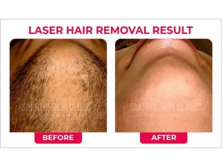 sakhiya-skin-clinic-noida-best-skin-hair-treatment-clinic-small-1