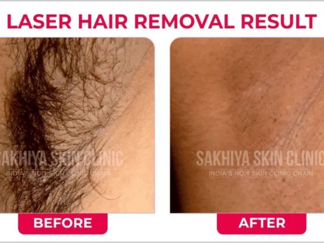 sakhiya-skin-clinic-noida-best-skin-hair-treatment-clinic