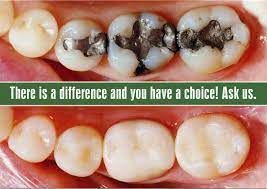 dental-fillings-restorations-near-sector-11-noida-big-0