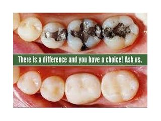 dental-fillings-restorations-near-sector-11-noida-small-0