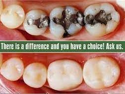 dental-fillings-restorations-near-sector-11-noida