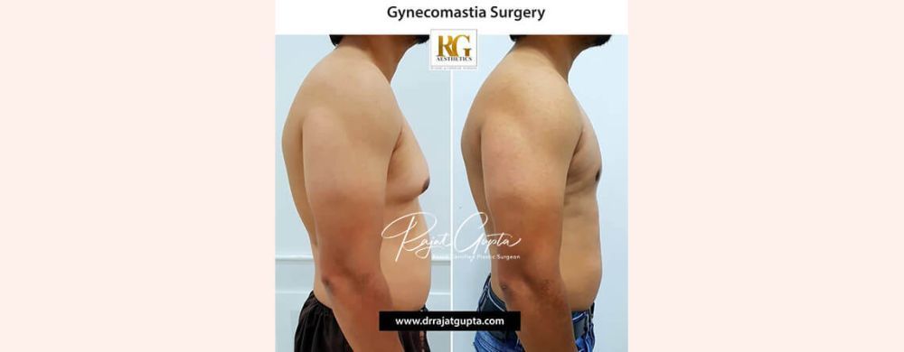 is-gynecomastia-a-big-surgery-what-you-should-really-expect-big-0