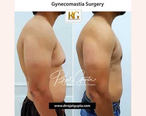 is-gynecomastia-a-big-surgery-what-you-should-really-expect
