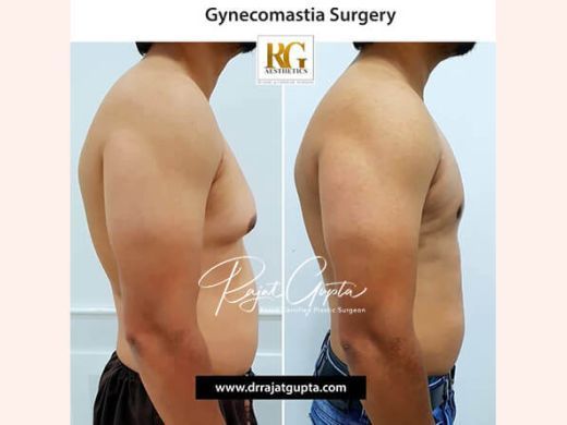 is-gynecomastia-a-big-surgery-what-you-should-really-expect