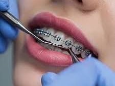 best-dental-brace-in-chetla-for-smile-alignment