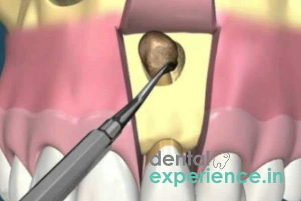 apicoectomy-root-surgery-kochi-kerala-big-0