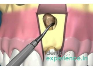 apicoectomy-root-surgery-kochi-kerala-small-0
