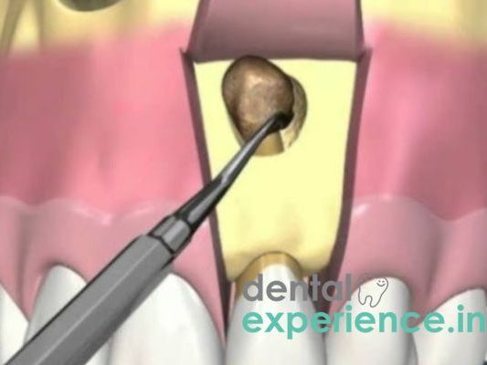 apicoectomy-root-surgery-kochi-kerala