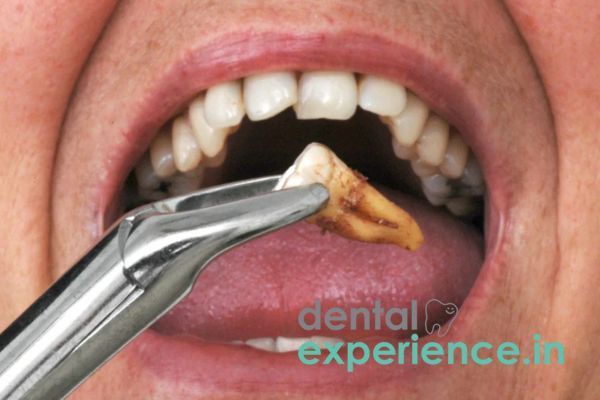 emergency-wisdom-tooth-removal-kochi-ernakulam-big-0