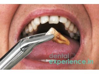 emergency-wisdom-tooth-removal-kochi-ernakulam-small-0