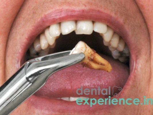 emergency-wisdom-tooth-removal-kochi-ernakulam