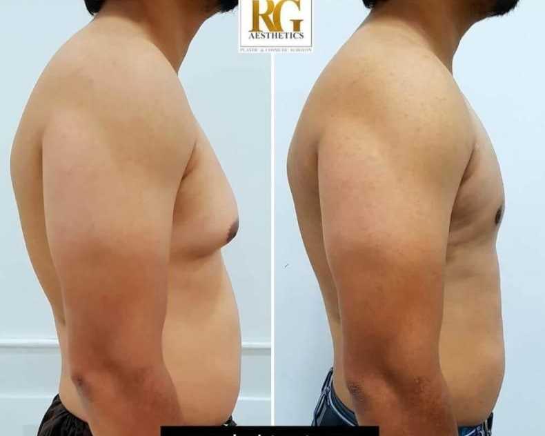 how-do-i-know-if-i-have-gynecomastia