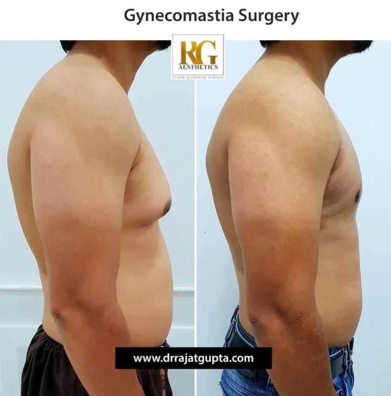 how-do-i-know-if-i-have-gynecomastia-big-0